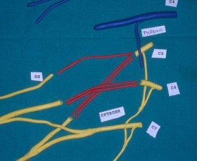 Lesione del plesso : cos'è - Microneurochirurgia Rovigo 