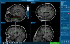 Neuronavigazione - Microneurochirurgia Rovigo 