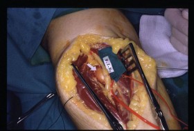 ( o entrapment neuropathies) - Microneurochirurgia Rovigo 