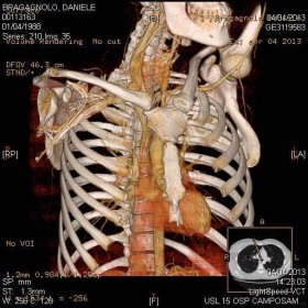 Sindrome dell'egresso toracico o TOS (thoracic outlet syndrome) - Microneurochirurgia Rovigo 