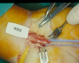 Sindrome del tunnel carpale - Microneurochirurgia Rovigo 